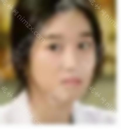 高允真整形前好不好看？内附前后对比图分享~