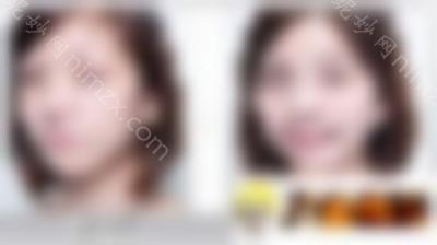 脸颊自体脂肪填充手术会有隐忧吗？如何避免手术风险？