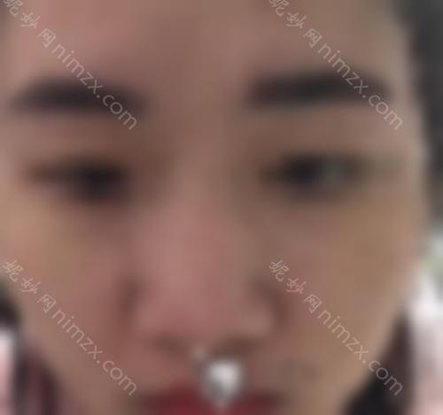 激光祛斑会留下疤痕吗？它的优缺点是什么？