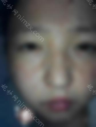 激光祛斑会留下疤痕吗？它的优缺点是什么？