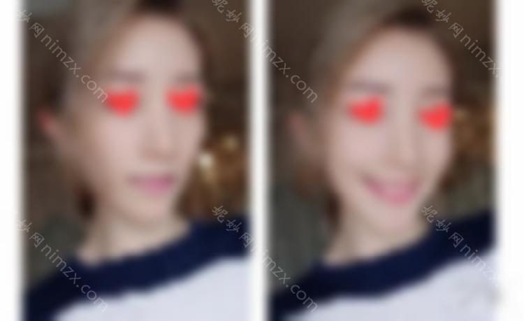 90之后，我已经开始做热玛吉了。让我们谈谈我个人的感受