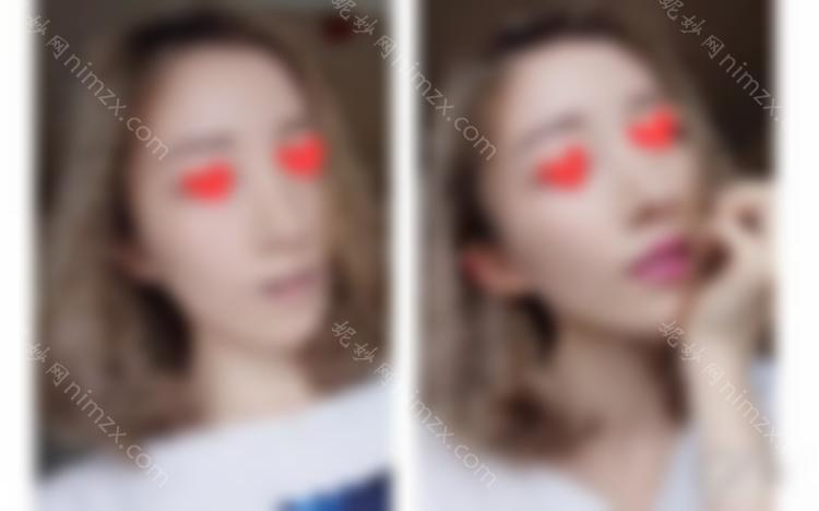 90之后，我已经开始做热玛吉了。让我们谈谈我个人的感受