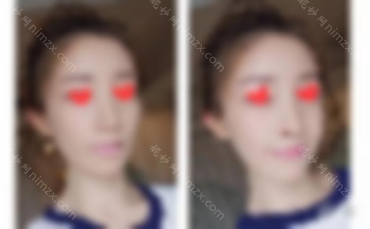 90之后，我已经开始做热玛吉了。让我们谈谈我个人的感受