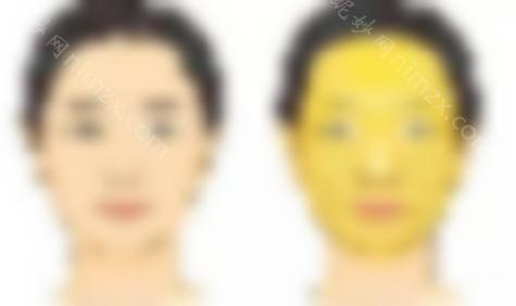 自体脂肪填充太阳穴的弊端有哪些？如何避免后遗症？
