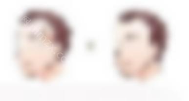 自体脂肪填充太阳穴的弊端有哪些？如何避免后遗症？