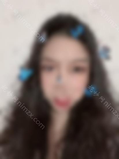 张冰洁医生双眼皮睁开眼角，眼睛瞬间变得有活力！