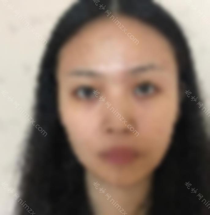 重医何光照隆鼻病例来袭：3个月后效果惊人！妈妈直呼认不出来