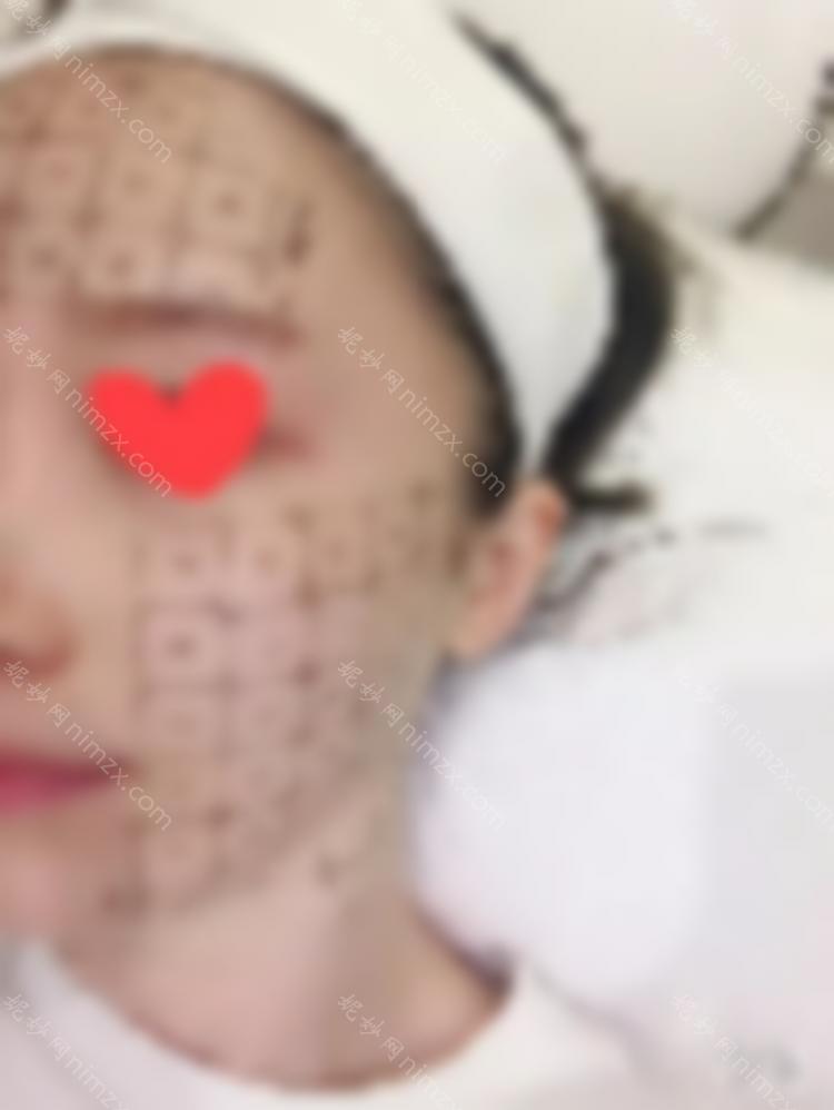 90之后，我已经开始做热玛吉了。让我们谈谈我个人的感受