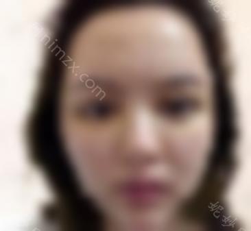 余晓波修复双眼皮好吗？余晓波医生真实技术分析 双眼皮修复案例