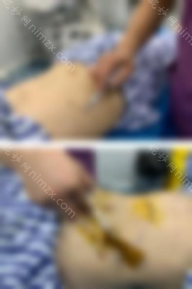 杭州薇琳王大勇医生的整形技术怎么样？医生技术评论 吸脂瘦腰案例效果