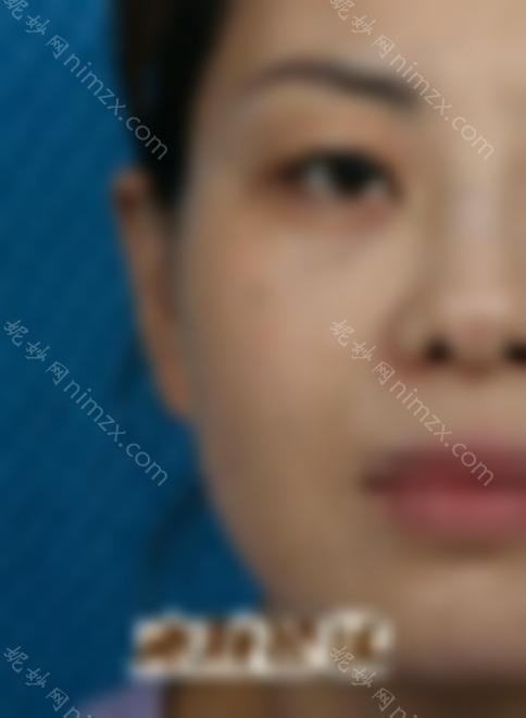 激光祛斑三天后的照片:真人祛斑效果对比，皮肤洁白无瑕~