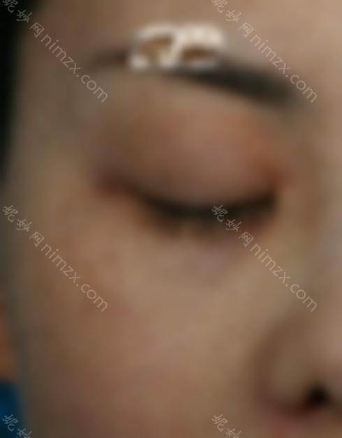 激光祛斑三天后的照片:真人祛斑效果对比，皮肤洁白无瑕~