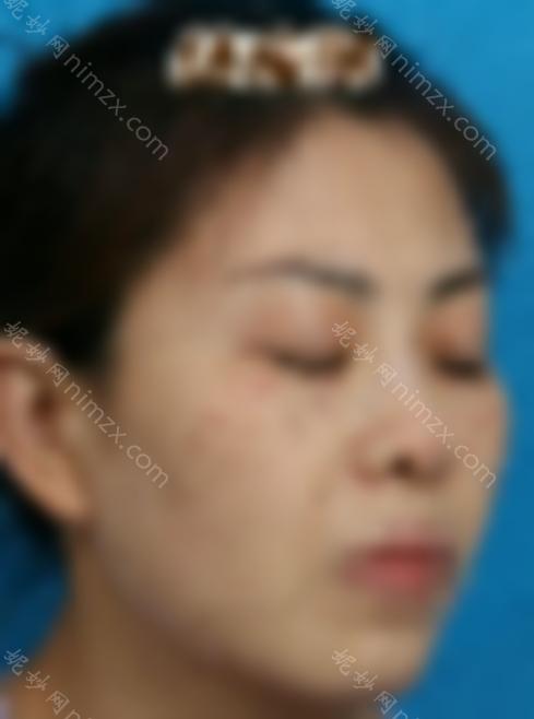 激光祛斑三天后的照片:真人祛斑效果对比，皮肤洁白无瑕~