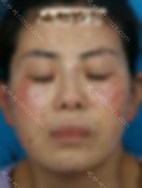 激光祛斑三天后的照片:真人祛斑效果对比，皮肤洁白无瑕~