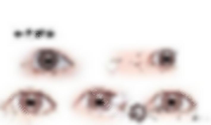开眼角外眼角容易留下疤痕吗？韩国开眼角的手术过程是什么？
