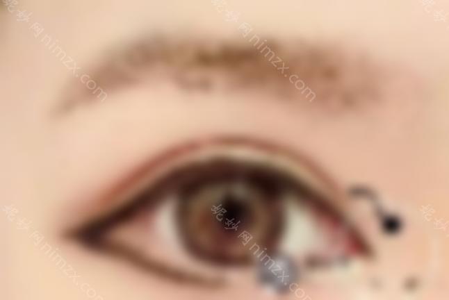 开眼角外眼角容易留下疤痕吗？韩国开眼角的手术过程是什么？