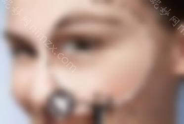 眼睛除皱要多少钱？分析价格影响因素，悄悄消除岁月痕迹~