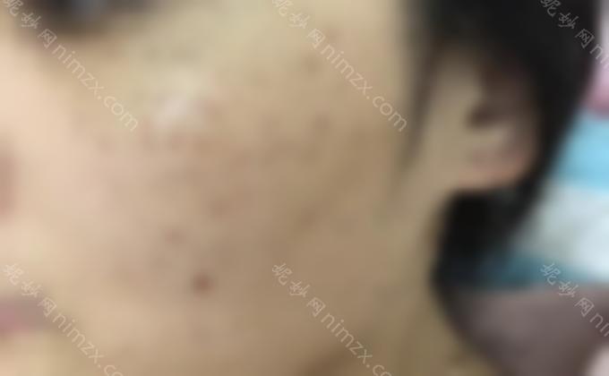 郑州集美整形激光祛斑多少钱？附上祛斑案例及价格表！