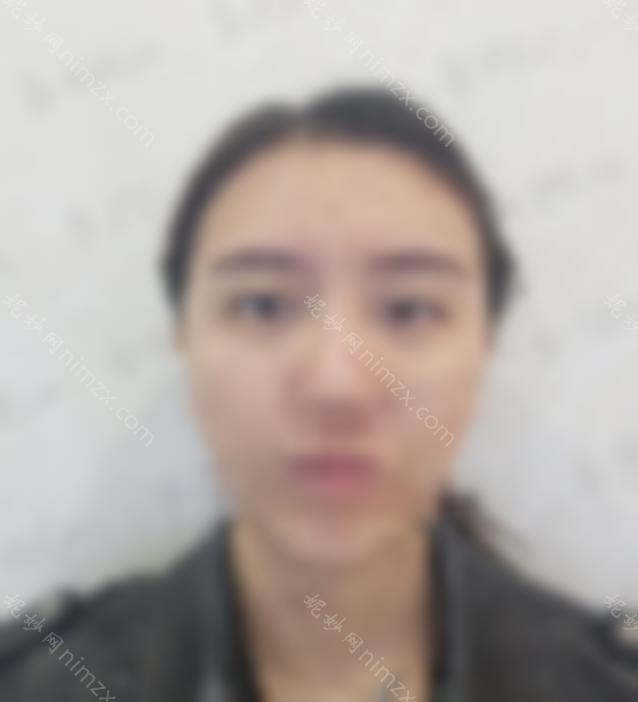 二附院刘月丽双眼皮修复的真实案例来了！看实际效果好不好