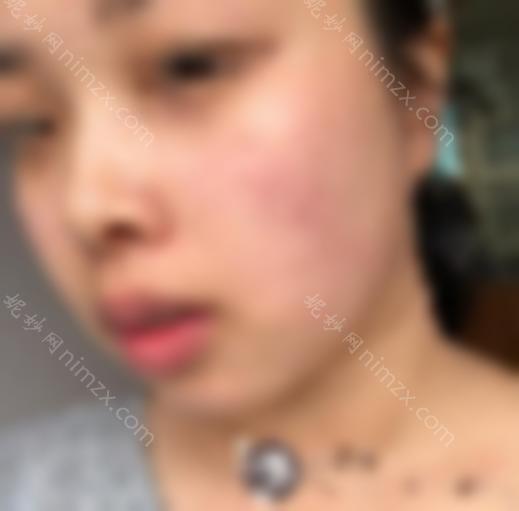 皮秒祛斑10天变化图片分享！分享我的个人过程！快来看看吧