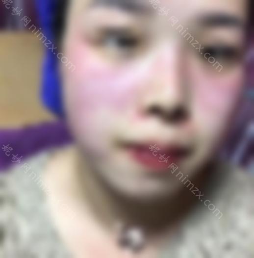 皮秒祛斑10天变化图片分享！分享我的个人过程！快来看看吧