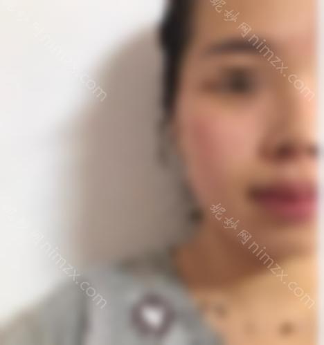 皮秒祛斑10天变化图片分享！分享我的个人过程！快来看看吧