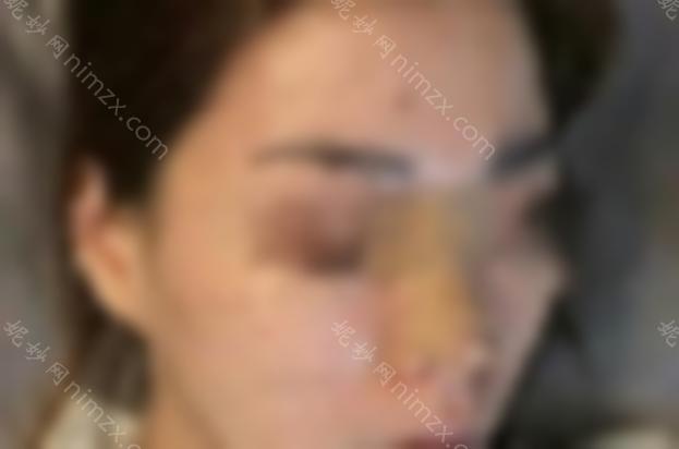 韩国三段隆鼻好吗？一次能持续多久？术后恢复期有哪些注意事项？