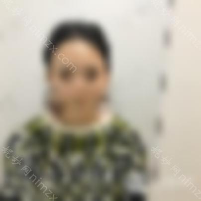 开眼角危险吗？真实开眼角案例分享(附图)