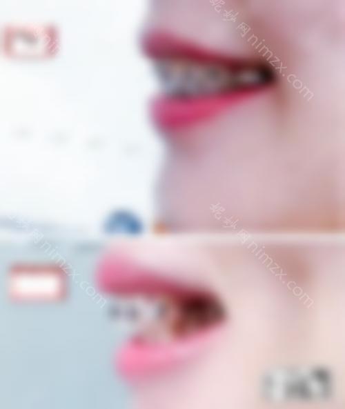 正畸拔牙的利弊分析：正畸拔牙有危险吗？有副作用吗？
