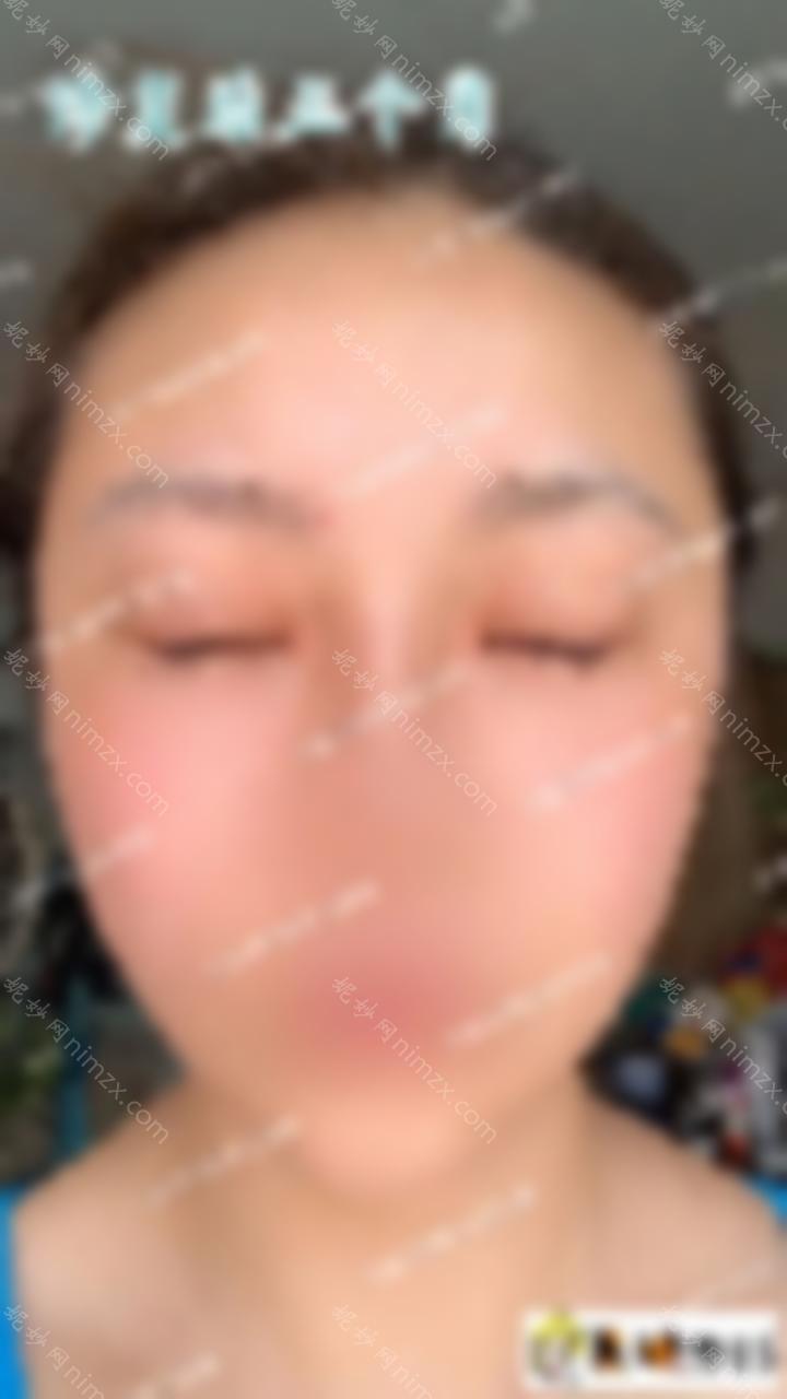 双眼皮修复让一双丑陋的眼睛变美！真实案例效果图！