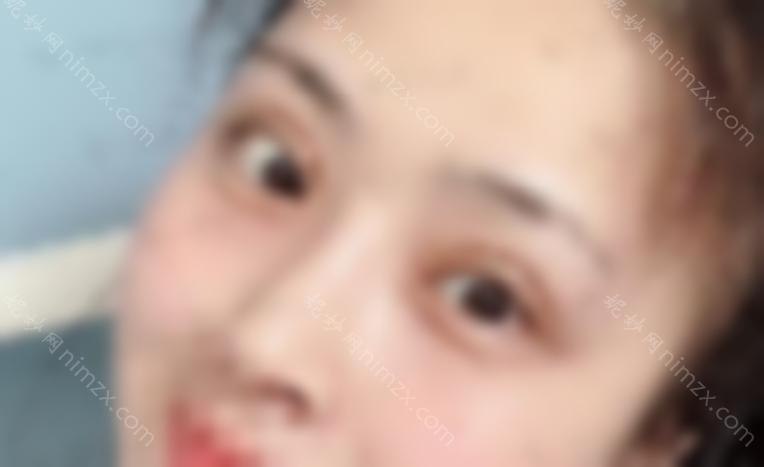 秦皇岛较好医院整形科无痕开眼角多少钱？开眼角手术效果好吗？