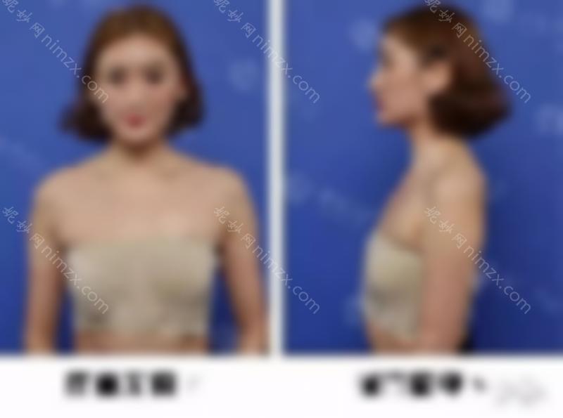 隆胸10年:重庆女性较喜欢的杯排名？答案很好open