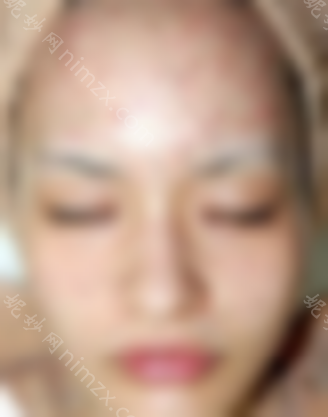 复合彩光祛痘效果如何？网友:不仅祛痘，皮肤也变好了。~