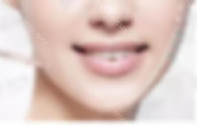 瘦脸*能定型多少次？术前需要特别注意什么？来看看吧