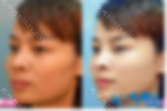 南宁东部中下部线雕提升案例如何揭示路世敏医生的整形技术？