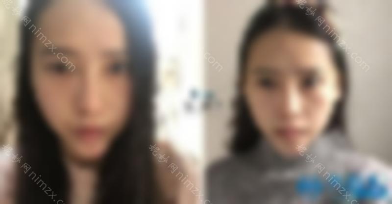 韩国DA整形外科医院V line 脂肪移植后三个月日记