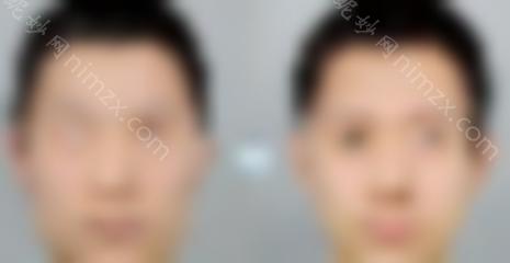 下颌角整形手术前后过程分享~男生做下颌角