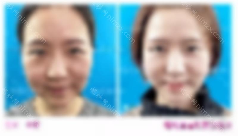 医美干货 | 你对切眉手术了解多少？
