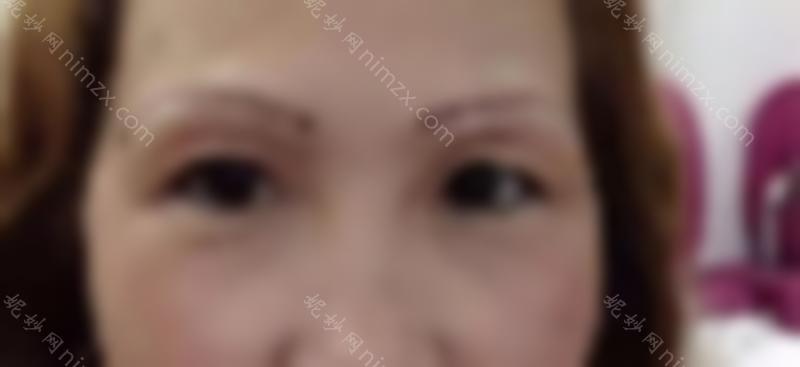医美干货 | 你对切眉手术了解多少？