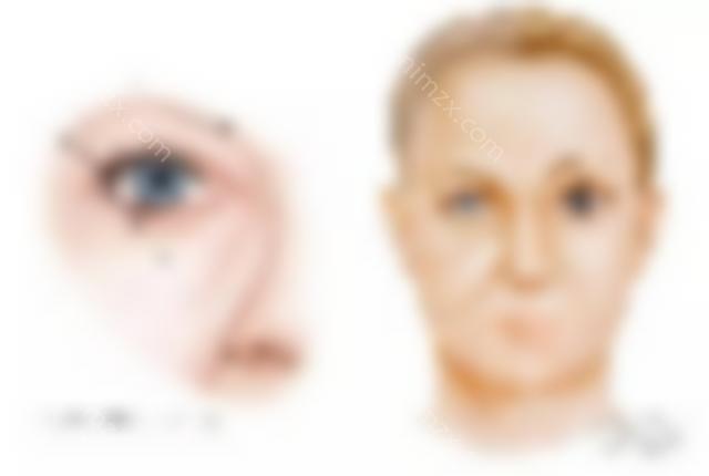 医美干货 | 你对切眉手术了解多少？