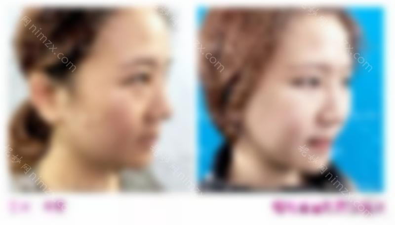 医美干货 | 你对切眉手术了解多少？