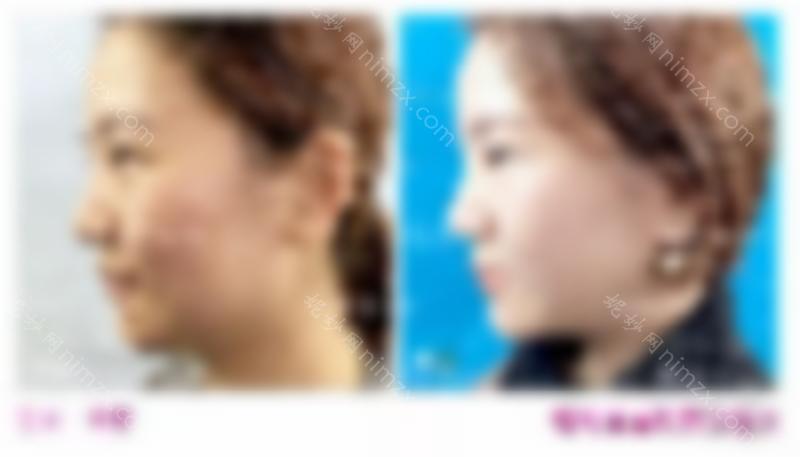医美干货 | 你对切眉手术了解多少？