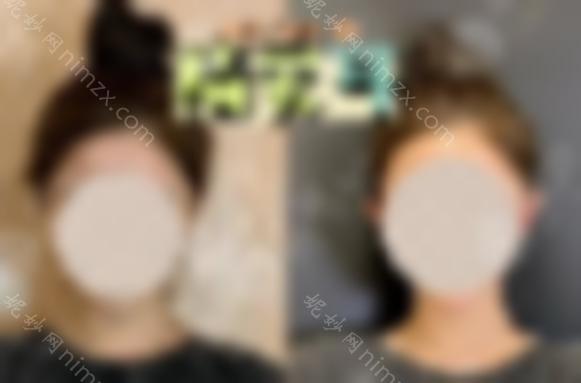 精灵耳朵怎么整形？爆红医美项目出圈，get完美耳廓~