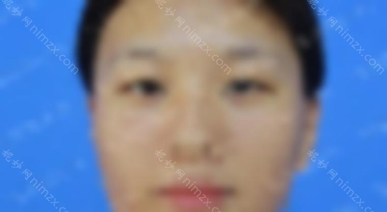 2022年济宁双眼皮修复名医推荐：孔祥红、刘郭、李鹰等5位实力上榜