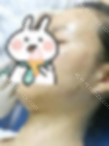 瘦脸*多久？注射瘦脸效果对比图，术后成为男神收割机！