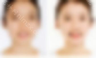 垫下巴要多少钱？