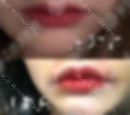 口唇整形项目有哪些？超全科普3种美唇方法，怦然动心！