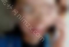 双美胶原蛋白注射丰唇效果怎么样？真人案例来喽！