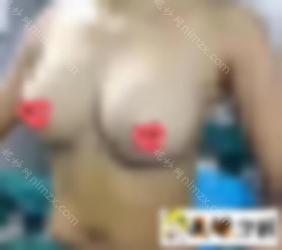 法国es分享假体隆胸记录~个人真实的手术经历是什么感觉？