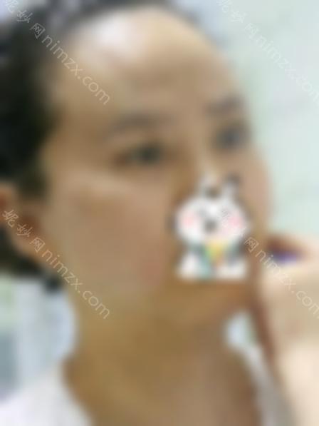 瘦脸*多久？注射瘦脸效果对比图，术后成为男神收割机！